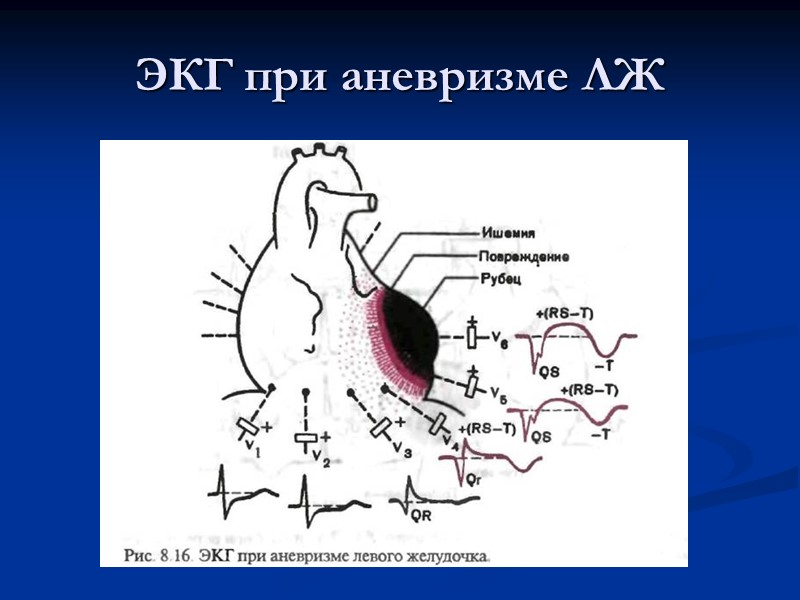ЭКГ при аневризме ЛЖ